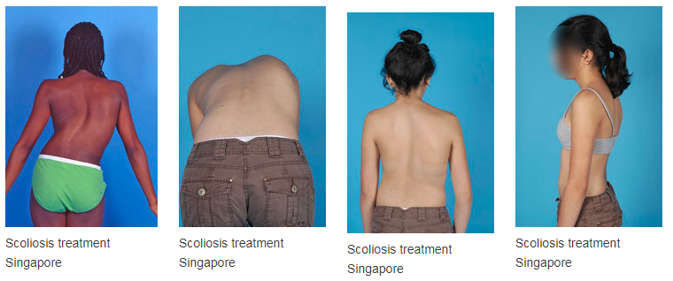 Scoliosis treatment Singapore