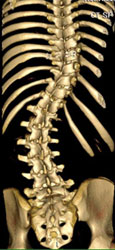 scoliosis treatment singapore